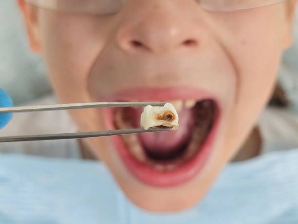 Best Emergency Tooth Extraction in Deschutes River Woods, OR